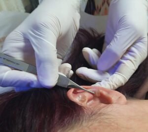 Acupuntura Auricular